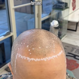 Bald & balding community tap in. 🧑🏽‍🦲🖋️

#scalpmicropigmentation#smp#hairtattoos
#scalptattoo#ro