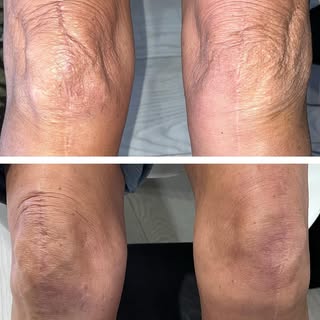 Now offering! Scar therapy treatments. These are before and after photos of only 3 treatments done o