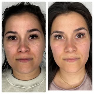 Before and after 4 treatments. No matter your age taking care of your skin is priority. Did you know