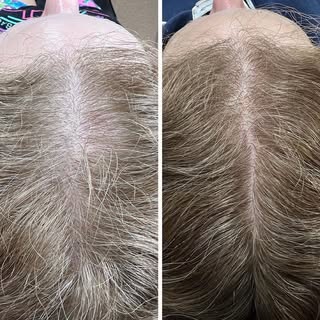 JET PLASMA HAIR RESTORATION is here. 
This advanced technology for hair restoration uses a powerful 