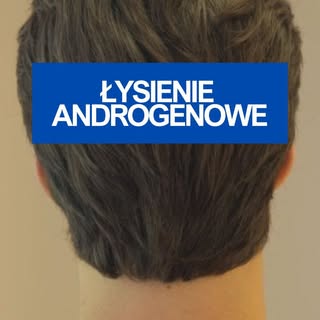 Czujesz, że Twoje włosy powoli znikają? 
Nie jesteś sam. Łysienie androgenowe dotyka miliony mężczyz