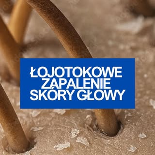 Swędzenie, łuszczenie, zaczerwienienie? To może być łojotokowe zapalenie skóry głowy. To przewlekły 