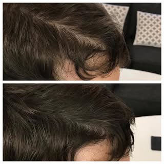 A subtle change for this client wanting to create a thicker look to the hair lining his parting. Int