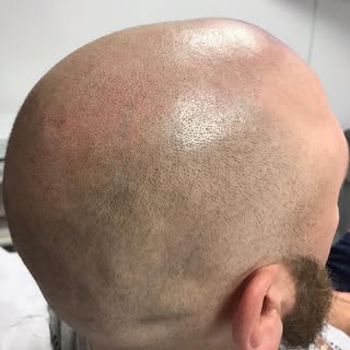 Midway through treatment for this client - stay tuned for the finished result, coming soon!

@coopyw