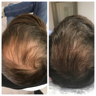 What a difference just 1 treatment makes! 🙌 For best results, this client will be having 2 more mic