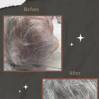 ✨Before and After Exosome Therapy Transformation! ✨ 

Are you tired of dealing with thinning hair, h