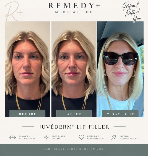 🔥WOW.

Beautiful lip filler is about more than volume, it’s about enhancing your natural shape. Thi