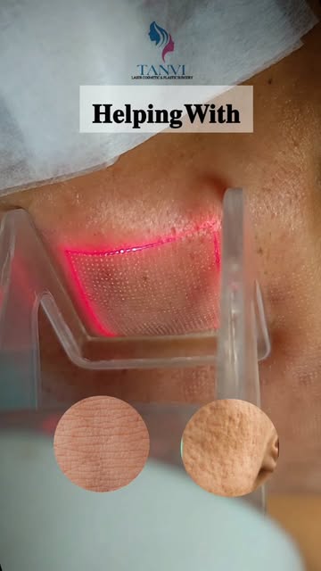 CO₂ Laser + Exosomes ✨ Glow. Renew. Rejuvenate.
Scar care. Skin renewal. ✨
Resurface. Repair. Glow.
