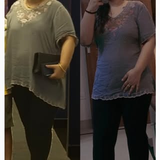 Before vs After of liposuction - Patient Story 
.
.
#cosmeticsurgery #liposuction