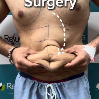 Years of Gym did skin loosing - tummy tuck patient story
.

.

.
#cosmeticsurgery