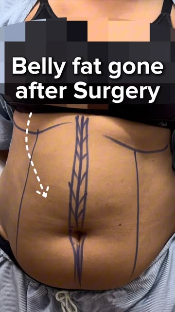 Mumbai patient liposuction story - best hospital for liposuction 
.

.
#liposuction