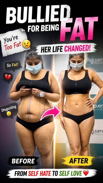 Bullied for fat - now have abs our patient story she came from Australia 
.

.
#cosmeticsurgery