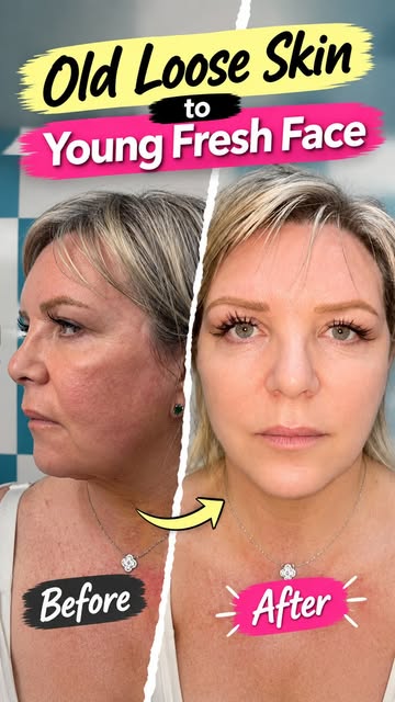 Old loose skin to young fresh face
.

.
#cosmeticsurgery