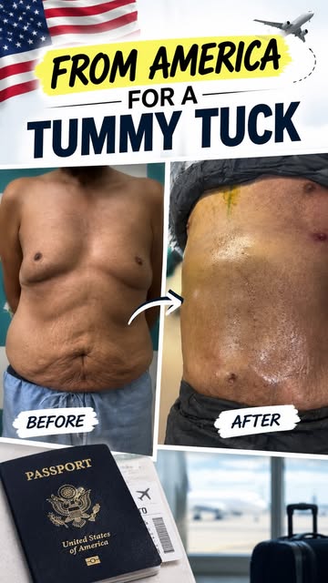 From america for tummy tuck surgery and stage 2 Gynocomestia 
.

.

.
#cosmeticsurgery