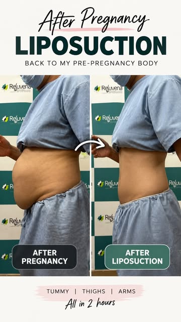 After Pregnancy belly fat gone in hours - Patient Story
.

.
#cosmeticsurgery