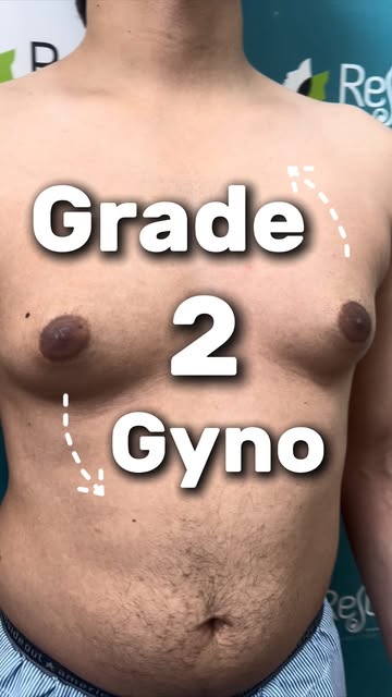 Grade 2 Gynocomestia - Delhi Patient
.

.

.
#cosmeticsurgery
