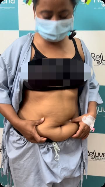 Problem with tummy - Liposuction Patient Story
.

.
#cosmeticsurgery