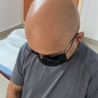 Scalpmicropigmentation or SMP is the only non-surgical, permanent and zero maintenance solution for 