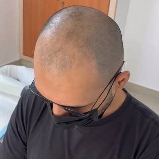 When confidence returns, everything changes.

Hair loss had slowly taken away more than just hair — 
