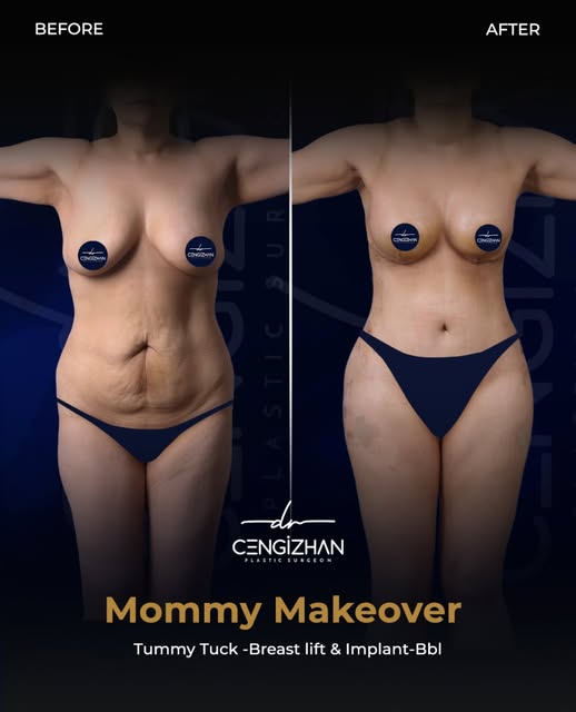 Mommy Makeover 🌟
✨ Tummy Tuck & Liposuction & Bbl & Breast Reduction + Lift  surgery with Dr. Cengi