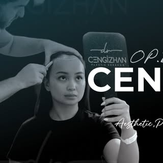Forehead Reduction 🌟
