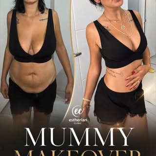 Mommy Makeover 🌟
✨ Tummy Tuck & Liposuction & Breast Implant + Lift  surgery with Dr. Cengizhan! ✨
