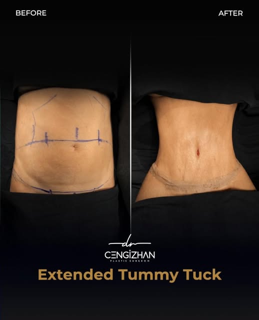 ✨ Tummy Tuck & Liposuction surgery with Dr. Cengizhan! ✨

📍 Contact us for details.

‼️ Results of 