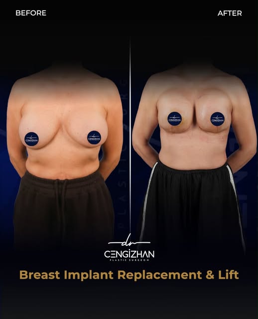 ✨Breast Implant Replacement & Lift surgery with Dr. Cengizhan! ✨

Post-Op 1 week 

📍 Contact us for