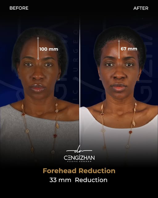 🇬🇧 Forehead Reduction with ‘C’ Reduction Technique with Dr. Cengizhan Ekizceli ✨

Post-op  1 week
