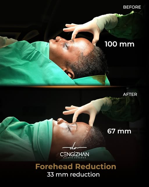 🇬🇧 Forehead Reduction with ‘C’ Reduction Technique with Dr. Cengizhan Ekizceli ✨

Post-op  1 week
