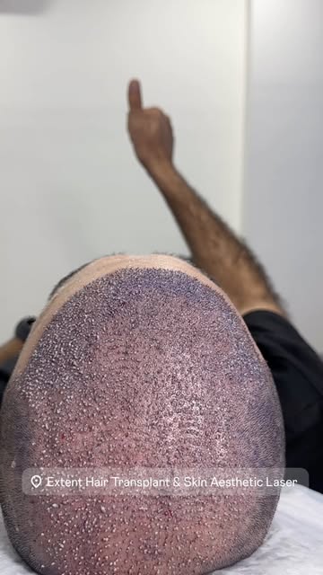FUE HAIR TRANSPLANT!
