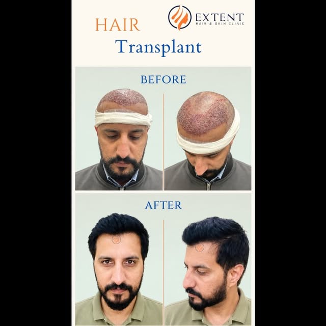 8-Month Hair Transplant Result | FUE Sapphire 
Here is our valued client, who has successfully compl