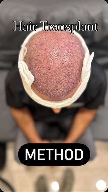 Hair Transplant..EXTENT ISLAMABAD KARACHI