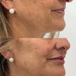“Doctora, quiero tener labios pero que se vean naturales.”💋

Es la frase que más escuchamos en cons