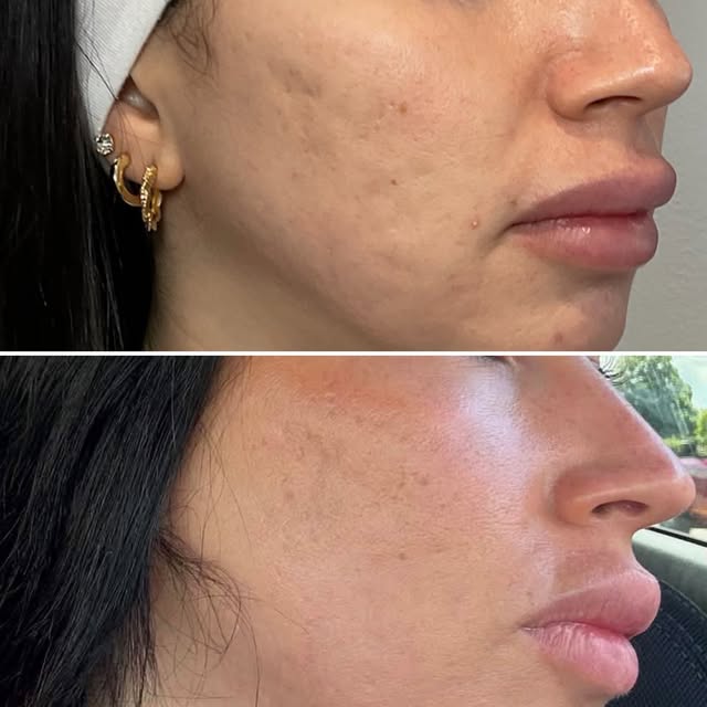 Here is great example of what an aggressive CO2 laser can do for acne scarring. 🪄 

This lovely pat