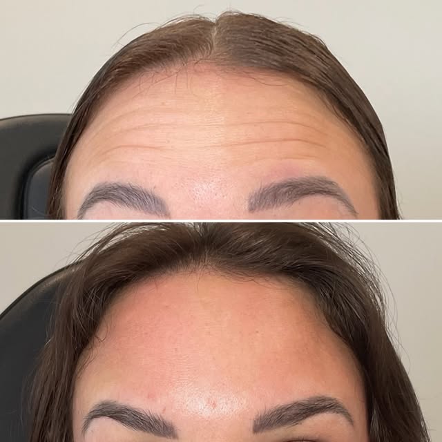 You can’t tell me you don’t want your forehead to glow like this!

Dysport does it again! 

If you’v