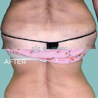 🔥 THE BACK & FLANK GLOW-UP IS REAL. 🔥

Just LOOK at these incredible results after EMSCULPT NEO® t