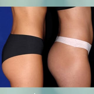 No squats? No problem. Just look at these results. 🍑

Our patient’s before & after EMSCULPT transfo