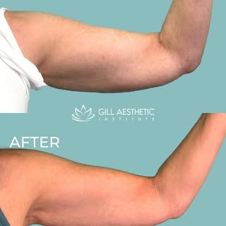Say hello to a more sculpted, defined look 💪✨

These amazing Emsculpt NEO® underarm results showcas