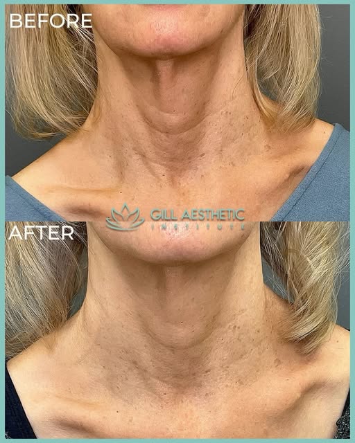 A neck transformation worth talking about! ✨ Double-tap ❤️❤️!

Our beautiful patient just finished h