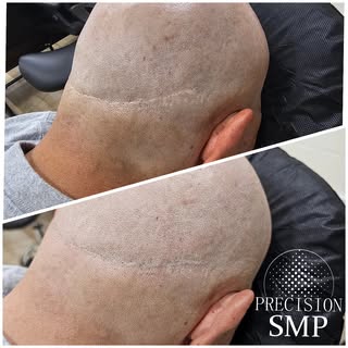 SMP is not just for the top of the head, it can also help camouflage any unsightly scars near hair a