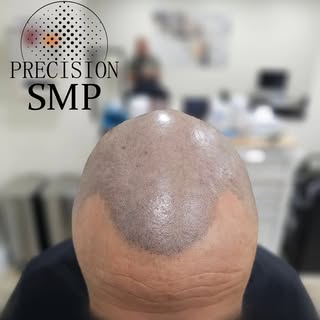 Part of the procedure is mapping out your hairline and together deciding what hairline and tones wil