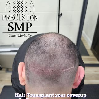 SMP can be both an alternative option or be combined with a hair transplant to get the best results.