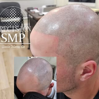 The hairline is a delicate part of the SMP process. Make sure you're SMP Artist is not a one style a