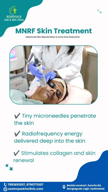 MNRF Treatment for Smoother, Healthier-Looking Skin

MNRF can help address acne scars, enlarged pore