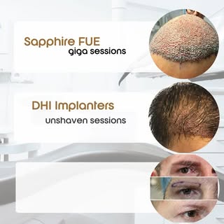 #hairtransformation #fyp #surgery #drtetianamamontova #hairtransplant #fue #hair #team #