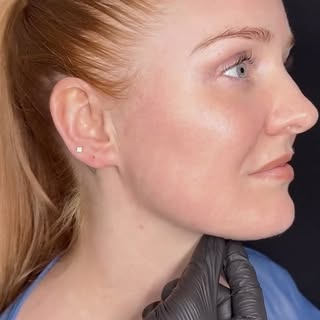 What do you think of @drsomjiskin’s signature Contour Once treatment?

Dr. Somji has been performing