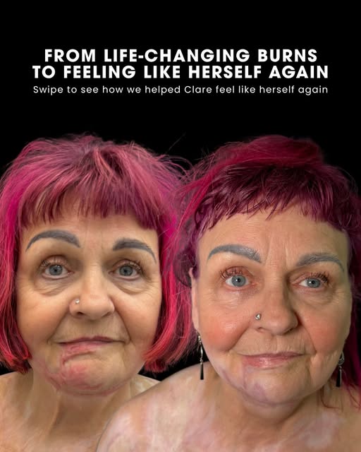 Some treatments go far beyond what we see on the surface.

For Clare, her scars were part of a journ