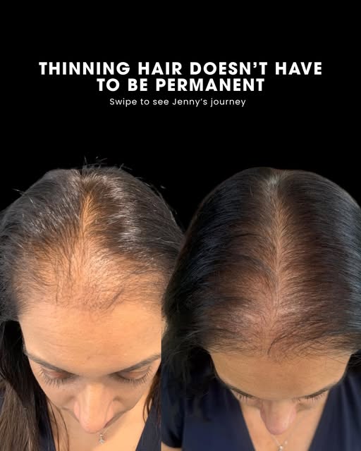 SAVE THIS if you’ve been noticing your hair becoming thinner…

Hair thinning can be incredibly perso
