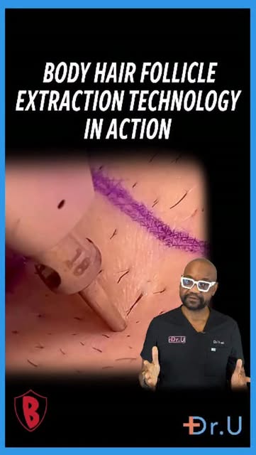 Sound on for the ultimate ASMR experience. 🔊

Watch Dr. Umar perform one of the more technically de